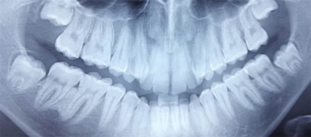 Clinical Case Spotlight: Nonsurgical Underbite Treatment
